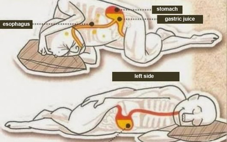 which side should i sleep on for heartburn