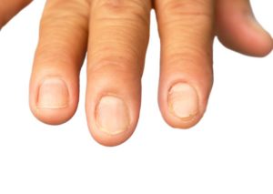 Nails and hair getting weaker due to protein deficiency