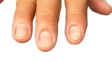 Nails and hair getting weaker due to protein deficiency