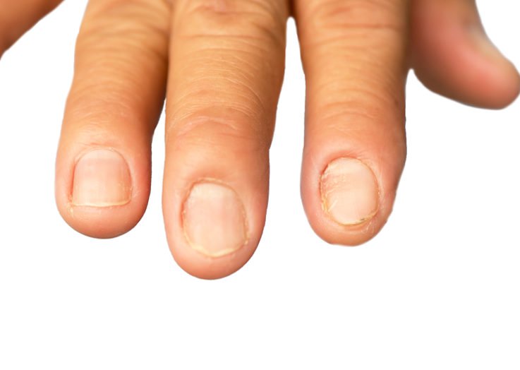 Nails and hair getting weaker due to protein deficiency 