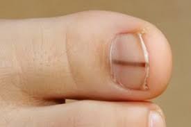 mark on your nail or your toenails can be a sign of melanoma