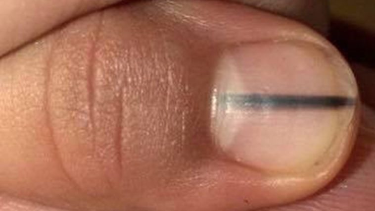 Melanoma can be detected if you see this mark on your nail