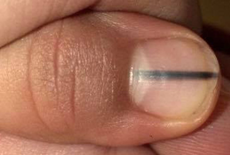 Melanoma can be detected if you see this mark on your nail