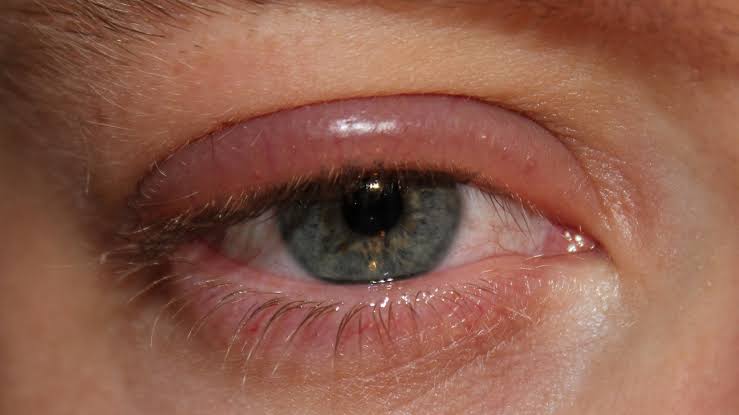 Eye infections example